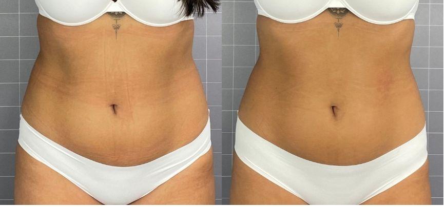 Abdomen 2 (5 séances)